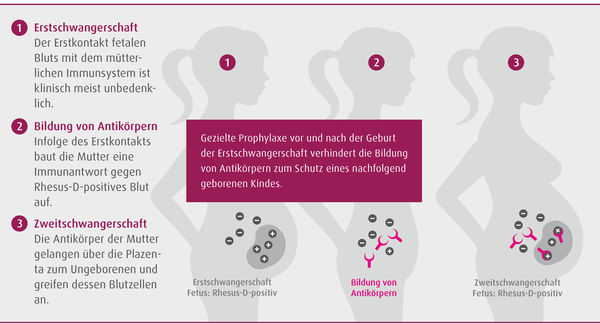 Schematische Darstellung der Ausprägung einer RhD-Inkompatibilität zwischen Mutter und Fetus.